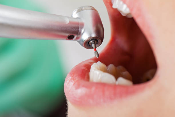 Best Emergency Root Canal Therapy in Peachtree City, GA